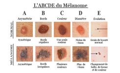 Comment reconnaître le cancer de la peau