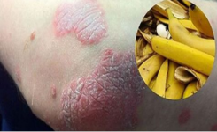 Les Utilisations de la Peau de Banane : Un Remède Naturel pour les Rides, les Verrues et le Psoriasis