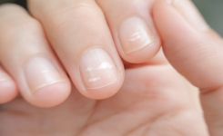 Que Signifient les Taches Blanches sur les Ongles ?