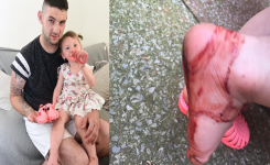 Une petite fille de 2 ans met sa nouvelle paire de sandales. 30 minutes plus tard, elle se retrouve avec les pieds ensanglantés