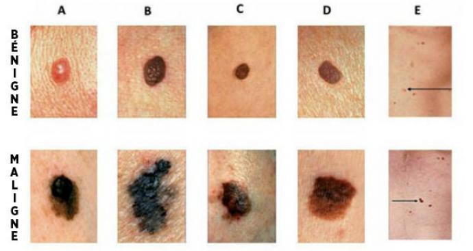 Comment Reconna tre Les Premiers Signes D un Cancer De La Peau Comment Reconna tre Les Premiers Signes D un Cancer De La Peau